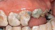 Oral Health - Gum & Tissue