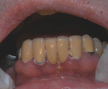 Oral Health - Gum & Tissue