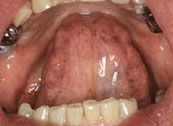 Oral Health - Saliva