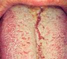 Oral health - Tongue